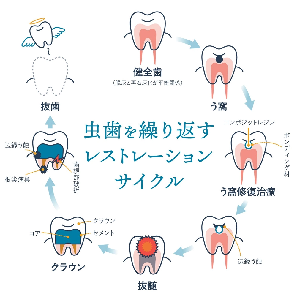 レストレーションサイクルを断ち切ることが歯を守る