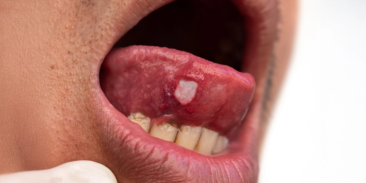 虫歯や歯周病だけではない「お口の病気」を診る口腔内科