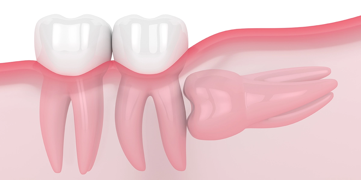 親知らずの抜歯