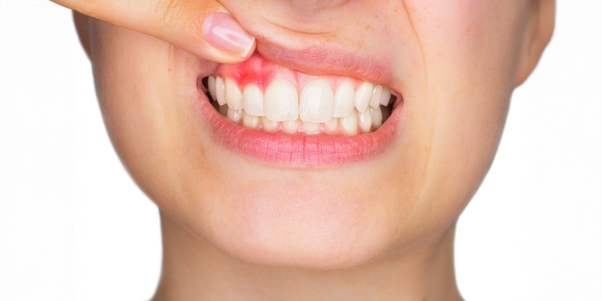 歯周病とは—歯を支える組織が徐々に破壊される感染症