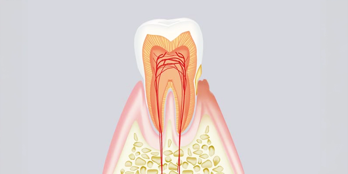 歯肉炎（初期段階）