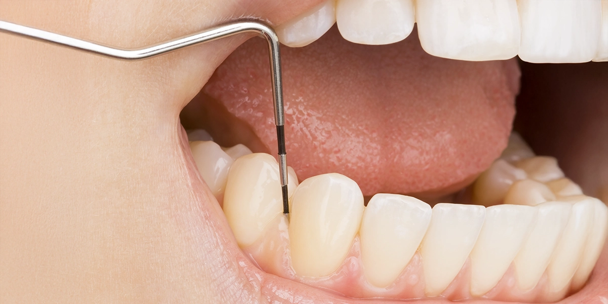 プロービング検査