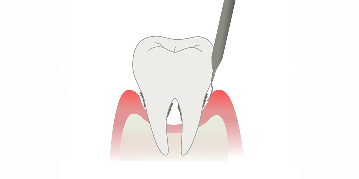 ルートプレーニング