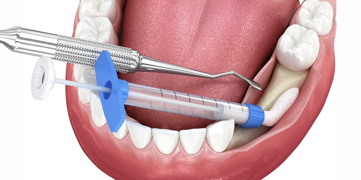 歯周組織再生療法