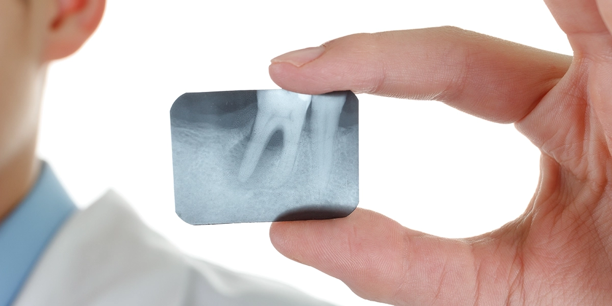 診査・診断：レントゲンと症状から治療計画を立てる