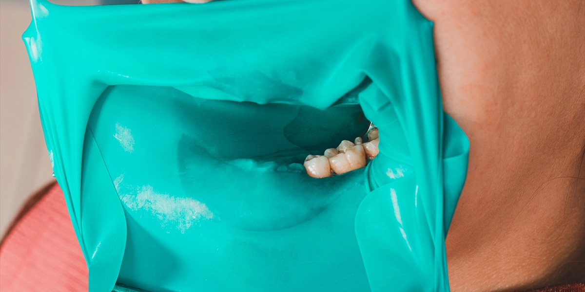 ラバーダムを使用した根管治療