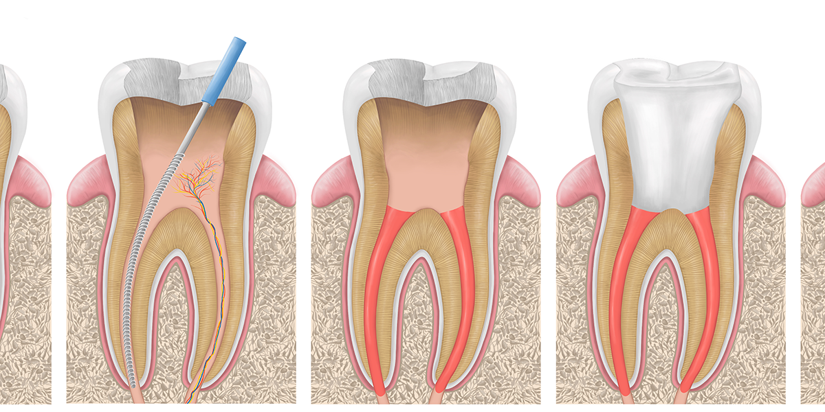 根管充填：根管を密封して再感染を防ぐ