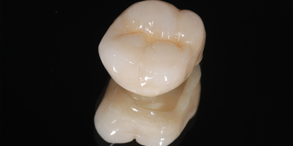 補綴処置：クラウンで歯を保護する