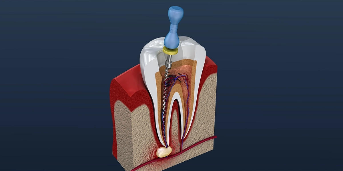 歯髄の除去と根管の清掃・消毒
